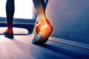 Excruciating pain from plantar fasciitus